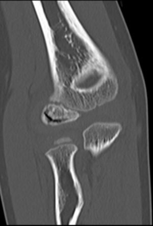 Tomografía computarizada, reconstrucción coronal oblicua. Se evidencia el aplanamiento del cóndilo humeral lateral y se detecta una lengüeta aérea subcortical indicativa de necrosis.
