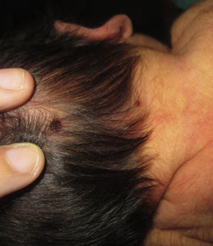 Pápula eritemato-marronácea recubierta por costra hemática en el cuero cabelludo.