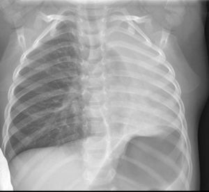 Atelectasia completa de pulmón izquierdo.