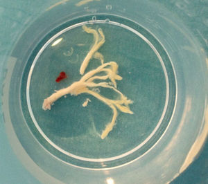 Molde bronquial extraído con broncoscopia rígida.