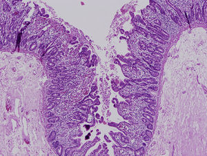 Hallazgos de la microscopia óptica. Tinción con hematoxilina-eosina que muestra una atrofia vellositaria moderada con ausencia de infiltrado inflamatorio en la lámina propia. Se observan agrupaciones de enterocitos formando penachos.