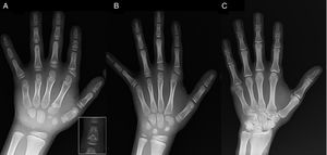 A) Radiografía de la mano izquierda del probando (7 años de edad cronológica y 5 años de edad ósea) con: acortamiento de un primer metacarpiano anómalo (doble epífisis, proximal y distal) y de falanges medias del segundo, tercer y quinto dedos. El segundo dedo muestra una desviación cubital y el cuarto dedo es el menos afectado, siendo el más largo de la mano izquierda. Las epífisis proximales de las falanges proximales del segundo y tercer dedos son displásicas, y llama la atención la forma de ángel de la falange media del segundo dedo (detalle en A). B). Radiografía de la mano izquierda de la hermana del probando (5 años y medio de edad cronológica, sin retraso en la edad ósea) con: acortamiento de las falanges medias del segundo, tercer y quinto dedos, sin afectación del cuarto. En este caso, el primer metacarpiano es normal. Destaca la forma triangular de la epífisis proximal de la falange proximal del segundo dedo, similar a la del hermano, y la forma trapezoidal de la del tercer dedo. Al igual que su hermano, el segundo dedo presenta desviación cubital. C) Radiografía de la mano izquierda del padre del probando, donde solo se aprecia un resto óseo correspondiente a una hexadactilia postaxial intervenida en la infancia.