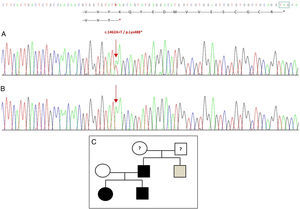 Mutación novel hallada en GDF5. A) Secuenciación del exón 2 del probando donde se observa el cambio c.1462A>T que da lugar a la aparición de un codón stop prematuro y a una proteína truncada (p.Lys488*) (seha indicado el codón stop natural en cuadrado verde). B) Misma secuencia normal de la madre sana. C) Árbol genealógico familiar: en negro se muestra al padre y ambos hijos con mutación demostrada en GDF5. En blanco, la madre sana. En gris, se muestra un hermano del padre con polidactilia postaxial bilateral, probablemente afectado.