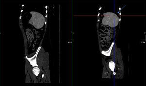 Corte sagital: en la imagen de la derecha (A) se muestra la lesión esplénica señalada con flechas. En la imagen de la izquierda (B) ha desaparecido.