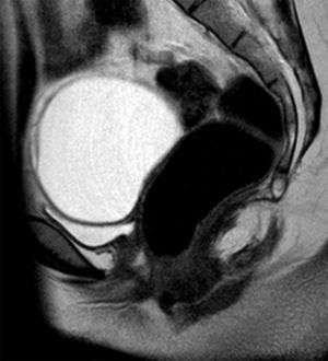 Resonancia magnética pélvica. Imagen sagital potenciada en T2 en la que se identifica un quiste de ovario improntando el techo de la vejiga y se puede identificar que la pared posterior de la vejiga y la anterior del recto están en contacto por la ausencia de útero y tercio superior de vagina.