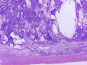 Microfotografía de un tumor del saco vitelino de tipo prepuberal puro en un niño de un año. Destaca el patrón macro- y microquístico del tumor del saco vitelino.