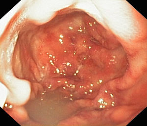 Mucosa de antro gástrico congestiva y edematosa con estenosis pilórica.