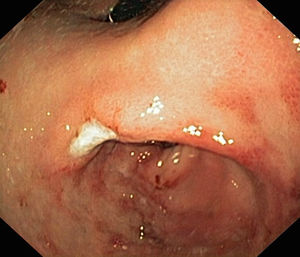 Mucosa gástrica edematosa y erosionada con estenosis pilórica y úlcera en cisura angular.