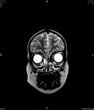 RMN cerebral, secuencia T2 en el que se aprecia encefalocele frontoetmoidal derecho.
