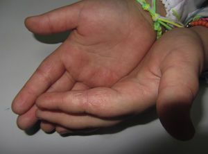Niña de 8 años con eccema de manos. Las pruebas epicutáneas mostraron positividad para Kathon (metilcloro-metilisotiazolinona) y formaldehído, considerándose de relevancia presente. Los alérgenos estaban presentes en los productos de manualidades que utilizaba habitualmente la paciente. Nótese la afectación de múltiples subunidades anatómicas.