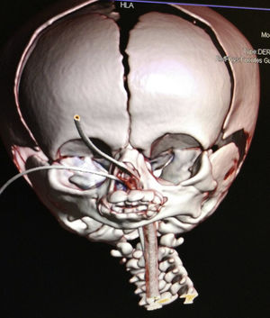 Fusión e hipoplasia mandibular en la TAC craneal.