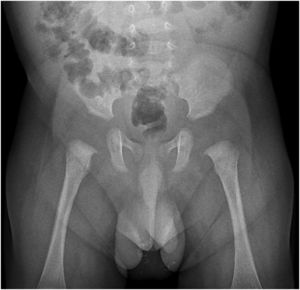 Radiografía simple de abdomen que muestra múltiples calcificaciones intraescrotales bilaterales.