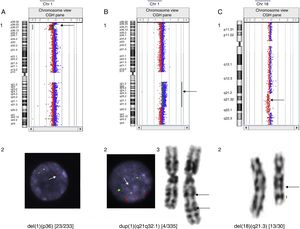 Casos de mosaicismos detectados por hibridación genómica comparada. A) Deleción 1p36 en mosaico en un paciente con cardiopatía: detectada mediante aCGH (1) y confirmada en un 9,8% de las células analizadas por FISH. Solo una única señal en el núcleo de la fotografía, indicada por la flecha, corresponde a la región 1p36 (2). B) Duplicación 1q21.1-q32.1 en un paciente con epilepsia: detectada mediante aCGH (1), confirmada en un 1,2% de las células analizadas por FISH. Las tres señales inferiores del núcleo de la fotografía, a las que se dirige la flecha, corresponden a la región 1q21q32.1 (2) y cariotipo (3). C) Deleción 18q21.31-q22.2 en un paciente con RGD: detectada mediante aCGH(1) y confirmada en un 43,3% de las células analizadas por cariotipo (2).