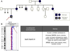 A) Pedigrí de una familia portadora de una deleción Xp22.33-p22.31. B) Resultado del análisis mediante aCGH, que implica la pérdida de los genes SHOX y ARSE, principales responsables de las alteraciones fenotípicas.