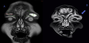 Resonancia magnética cerebral con imágenes en corte coronal potenciadas en T2 (A) y T1 (B) realizada tras 9 días de tratamiento con antibióticos intravenosos que muestra área de hiperintensidad (flecha azul) palpebral bilateral con dimensiones de 17,30×8,99 mm para el párpado derecho y de 20,60×9,12 mm para el párpado izquierdo. Se observa compromiso de los senos etmoidales y en el área donde inician su formación los senos frontales, además de reacción perióstica frontal.