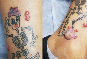 A) Pápulas inflamatorias confinadas a la tinta roja del tatuaje. B) Lesión hiperqueratósica en tobillo.