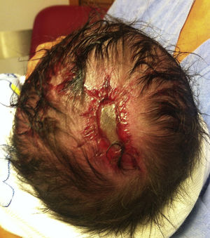 Neonato con una única lesión por aplasia cutis congénita en el cuero cabelludo.