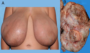 A: imagen de las mamas patológicas. B: imagen macroscópica de la pieza quirúrgica.