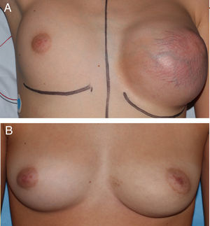 A. Tumoración mamaria del caso 1 previo a la cirugía. B. Resultado tras resección simple de la lesión.