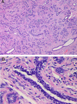 A. Estudio histológico del caso 3. Proliferación fibroepitelial con áreas de patrón pericanalicular e intracanalicular. No existe una marcada proliferación estromal, infiltración adiposa ni formación de hendiduras. B. Detalle de figura A (HE, 4X), se observa un epitelio de características levemente hiperplásicas y un estroma sin atipias citológicas ni mitosis.