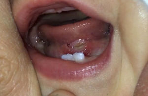 Úlcera en suelo de la boca de aproximadamente 1cm de diámetro, borde indurado con fondo de coloración blanquecina y halo eritematoso en periferia.