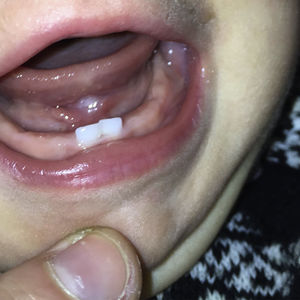Mejoría significativa de la úlcera un mes después del limado de los dientes.