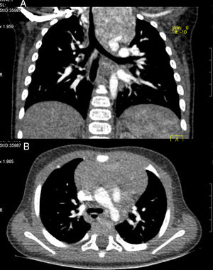 A y B) Hemangioma mediastínico.