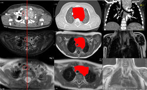 Evolución del hemangioma mediastínico hasta los 5 meses del tratamiento con propranolol. Línea: línea media. Círculo: tráquea. Nótese cómo se va haciendo medial y de mayor diámetro. Área delineada: masa mediastínica. Note cómo va disminuyendo de tamaño.