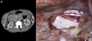 A) Tomografía abdominal donde se aprecia lesión lineal con contenido aéreo en L1 (trayectoria del puñal). B) Imagen intraoperatoria tras la laminectomía L1-L2 donde se aprecia un corte limpio a nivel dural (+: duramadre; *: raíz nerviosa).