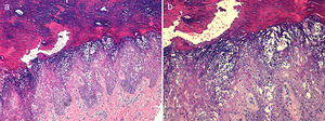 a) Hiperqueratosis compacta con cambios degenerativos vacuolares en segmentos superiores de epidermis (hematoxilina-eosina, ×100). b) Degeneración vacuolar de queratinocitos de estratos espinoso y granular, y presencia de múltiples gránulos citoplasmáticos eosinófilos (hematoxilina-eosina, ×200).