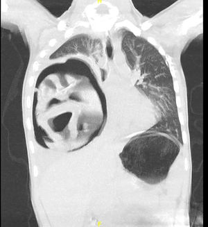 TC de tórax corte coronal. Gran lesión quística derecha con nivel hidroaéreo, atelectasia lobar media e inferior y desplazamiento mediastínico contralateral.