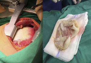 Imagen intraoperatoria de exéresis del quiste.