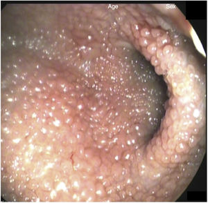 Mucosa gástrica de aspecto nodular y friable.