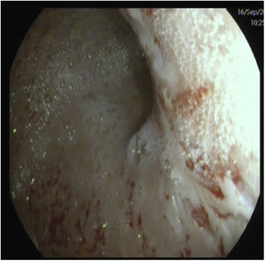 Mucosa a nivel de antro pilórico de aspecto atrófico.