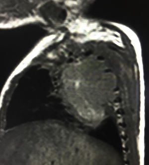 Masa en mediastino posterior paravertebral derecho de 5,5×4,6× 4cm (L×T×AP) con extensión a canal intraespinal desde D2 a D5.