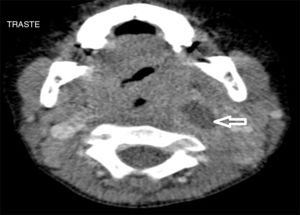 TAC de absceso parafaríngeo. Proyección axial.