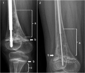 1) OI-VI tratada con denosumab; 2) Evolución radiológica tras 4 años de tratamiento; a: imagen en «nube de humo»; b: banda hiperintensa; c: líneas cebra.