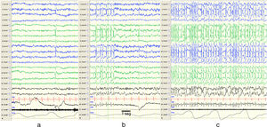 Cambios en el EEG. Muestra fragmentos de un EEG de siesta de la misma paciente en vigilia (a), sueño REM (b) y sueño no REM (c). Se objetivan durante el sueño no REM descargas de puntas y ondas de forma sincrónica sobre ambos hemisferios de forma continua, compatibles con POCS. Se ha registrado en el EEG la equivalencia a 1seg. Características del EEG: sensibilidad 10μV/mm; HF 70Hz; TC 0,3.