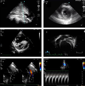 Imágenes de ecocardiografía a pie de cama correspondientes a diversas situaciones clínicas. A)Colapso inspiratorio de la vena cava inferior en un plano subcostal. Signo indicativo de hipovolemia en contexto clínico compatible. B)Colapso sistólico del ventrículo izquierdo en un plano paraesternal (eje corto). Signo indicativo de hipovolemia en contexto clínico compatible. C)Imagen compatible con ventrículo derecho dilatado y rectificación septal. Sugestivo de hipertensión pulmonar. D)Imagen de dilatación del ventrículo izquierdo en el contexto de pacientes con cuadro de inestabilidad hemodinámica, sugestiva de disfunción ventricular grave. E)Ductus arterioso persistente grande en prematuro. F)Imagen doppler a nivel de la arteria pulmonar izquierda con aumento de la velocidad del flujo telediastólico sugestivo de hiperaflujo pulmonar y ductus hemodinámicamente significativo.