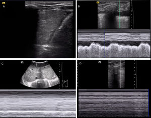 Diagnóstico de diferentes patologías respiratorias mediante ecografía a pie de cama. A)Consolidación del parénquima pulmonar con derrame pleural asociado. B)Identificación de derrame pleural empleando el modoM (signo del sinusoide). C)Evaluación de la motilidad diafragmática empleando el modoM con ausencia de excursión diafragmática (compatible con paresia diagragmática). D)Ausencia de deslizamiento pleural mediante modoM sugestiva de neumotórax (signo de la estratosfera o código de barras).