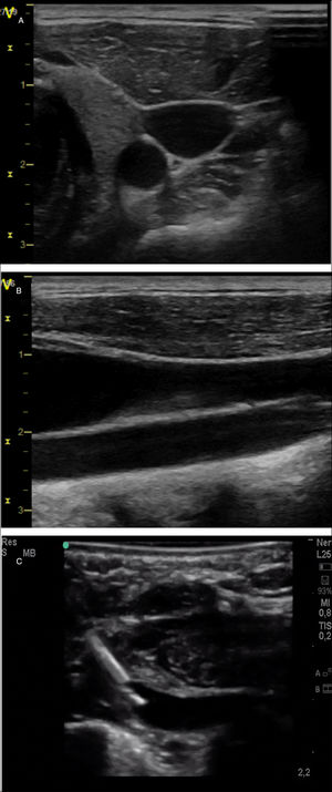 Exploración vascular cervical con ecografía a pie de cama. A)Corte transversal de los vasos identificando la arteria carótida como estructura hipoecoica redondeada y la vena yugular como estructura hipoecoica ovalada algo más superficial. B)Corte longitudinal de los vasos; se identifican la vena yugular a nivel más superficial y la arteria carótida a nivel profundo. C)Imagen de una canalización de la vena subclavia en un paciente neonato mediante abordaje longitudinal en plano.