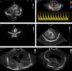 Exploraciones cerebrales realizadas en neonatos mediante ecografía a pie de cama. A)Corte coronal en que se observa imagen hiperecoica compatible con hemorragia intraventricular con desplazamiento de la línea media. B)Estudio doppler de la arteria pericallosa en paciente con hidrocefalia descompensada que muestra aumento de la resistencia (índice de pulsatilidad de 1,94) compatible con aumento de la presión intracraneal. C)Corte coronal que muestra una lesión hiperecogénica en la región frontal. D)Ecografía realizada a través de ventana transtemporal en la que se observa una lesión hiperecogénica compatible con hemorragia que desplaza la línea media. E)Cortes coronal (izquierda) y sagital (derecha) de un paciente neonato con meningitis en el que se observa dilatación ventricular.