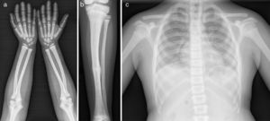 Serie ósea: esclerosis de huesos tubulares (a, b) con fracturas de estrés y patológicas (b). Aumento de densidad ósea generalizada, mayor en costillas y cuerpos vertebrales (c).