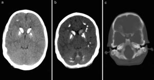 TAC cerebral: groseras calcificaciones intracraneales en sustancia blanca, ganglios de la base (a, b) y cerebelo (b). Engrosamiento de la cortical en la calota craneal que invade la esponjosa con desaparición del aspecto de diploe. Esclerosis densa en la base de cráneo que condiciona estenosis en canales nerviosos (c).