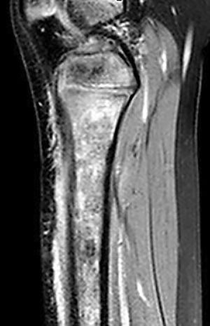 Resonancia magnética de miembro inferior. Corte sagital ponderado en densidad protónica con supresión grasa que muestra áreas heterogéneas hiperintensas en médula ósea y tejidos blandos de la región anterior de la tibia, debido a edema y cambios inflamatorios.