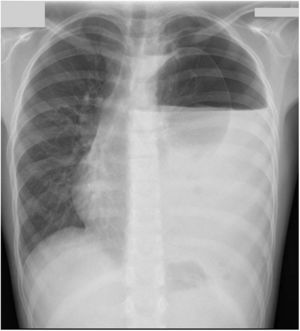 Radiografía de tórax. Gran hidroneumotórax izquierdo con desplazamiento contralateral del mediastino.