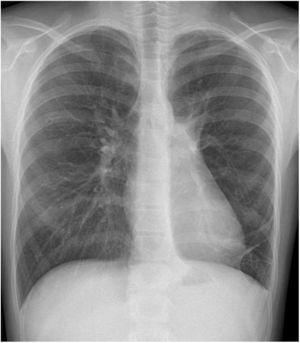 Radiografía de tórax. Resolución del hidroneumotórax izquierdo con reexpansión del parénquima pulmonar izquierdo.