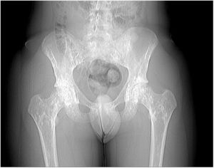 Radiografía de caderas.
