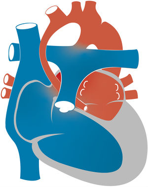 Representación esquemática de síndrome de corazón izquierdo hipoplásico. Nótese el infradesarrollo de las estructuras del lado izquierdo del corazón.