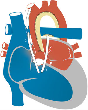 Representación esquemática del procedimiento del estadio 1. Se representan distintas fuentes del flujo pulmonar: fístula Blalock-Taussig modificada (1), conducto del ventrículo derecho a la arteria pulmonar situado a la derecha (2) o a la izquierda (3) de la neoaorta.